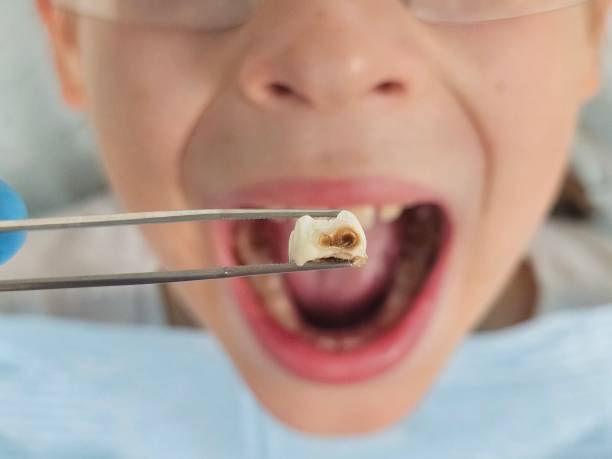 Best Knocked-Out Tooth (Avulsed Tooth) Treatment in Parkway, CA